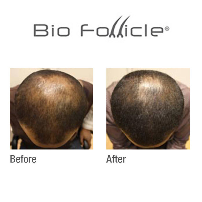 (HSS) Normal Hair Treatment Spray Hair Care Bio Follicle 